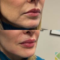Lip Filler Before & After Gallery - Patient 226548 - Image 1