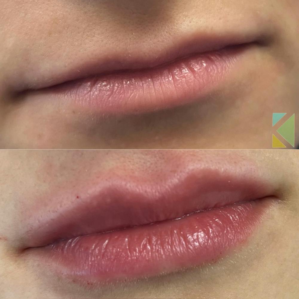 Lip Filler Before & After Gallery - Patient 370628 - Image 1