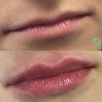 Lip Filler Before & After Gallery - Patient 370628 - Image 1