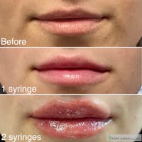 Lip Filler Before & After Gallery - Patient 247179 - Image 1