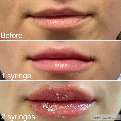 Lip Filler Before & After Gallery - Patient 247179 - Image 1