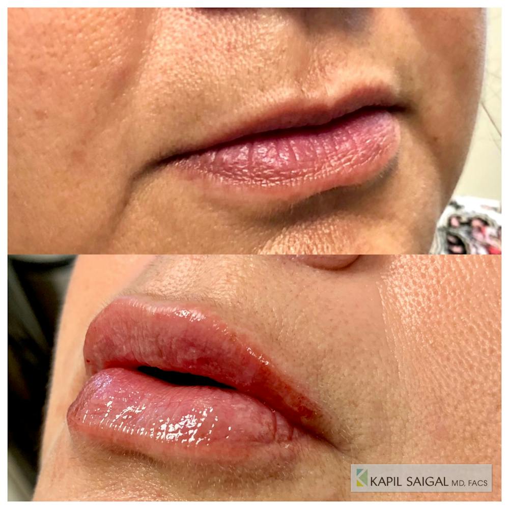 Lip Filler Before & After Gallery - Patient 136563 - Image 1