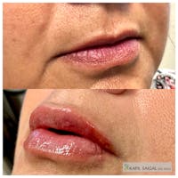 Lip Filler Before & After Gallery - Patient 136563 - Image 1