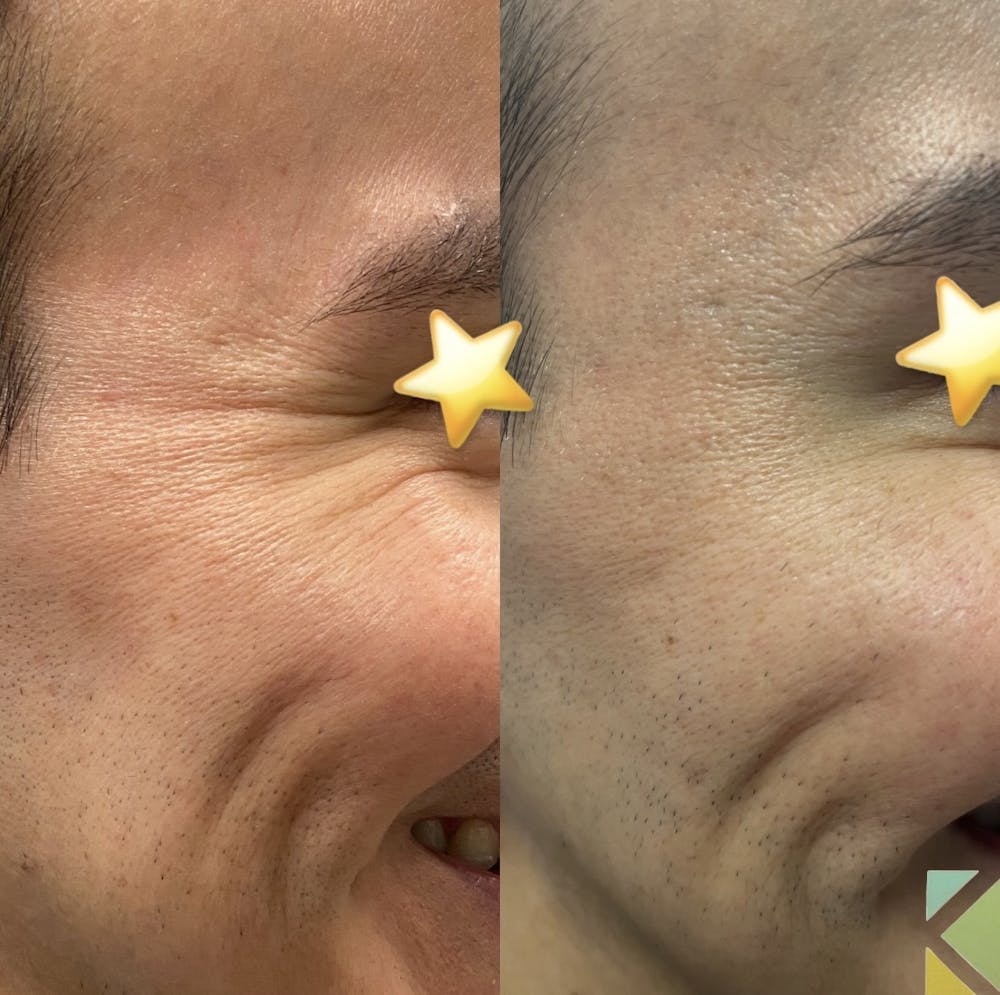 Botox Before & After Gallery - Patient 413661 - Image 1