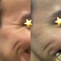 Botox Before & After Gallery - Patient 413661 - Image 1