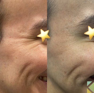 Botox Before & After Gallery - Patient 413661 - Image 1