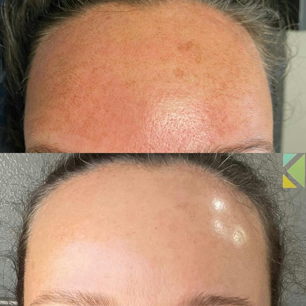 CO2 Laser Resurfacing Before & After Gallery - Patient 259189 - Image 1