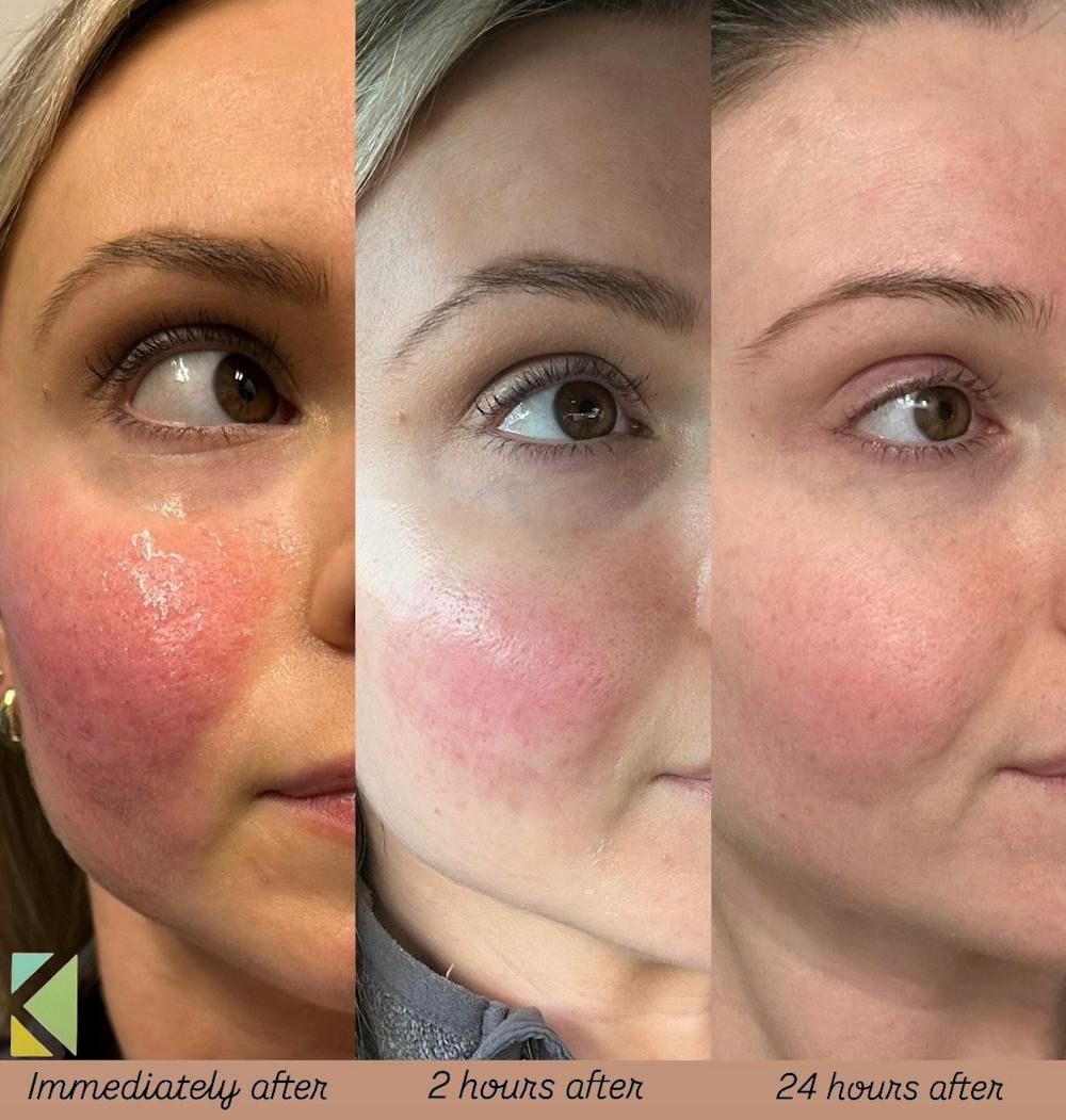 CO2 Laser Resurfacing Before & After Gallery - Patient 106738 - Image 1