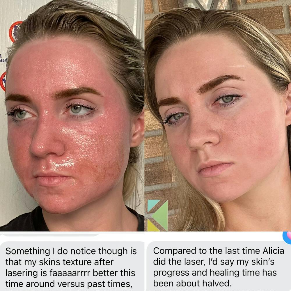 CO2 Laser Resurfacing Before & After Gallery - Patient 144042 - Image 1