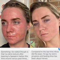 CO2 Laser Resurfacing Before & After Gallery - Patient 144042 - Image 1
