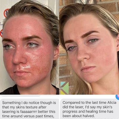 CO2 Laser Resurfacing Before & After Gallery - Patient 144042 - Image 1