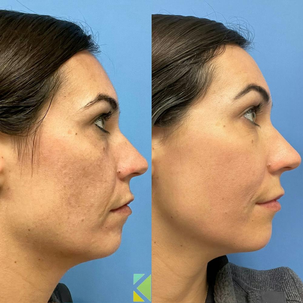 CO2 Laser Resurfacing Before & After Gallery - Patient 272214 - Image 2
