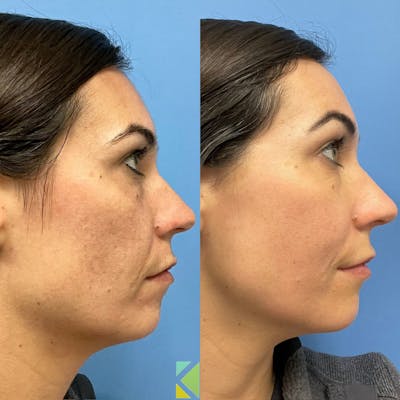 CO2 Laser Resurfacing Before & After Gallery - Patient 272214 - Image 2