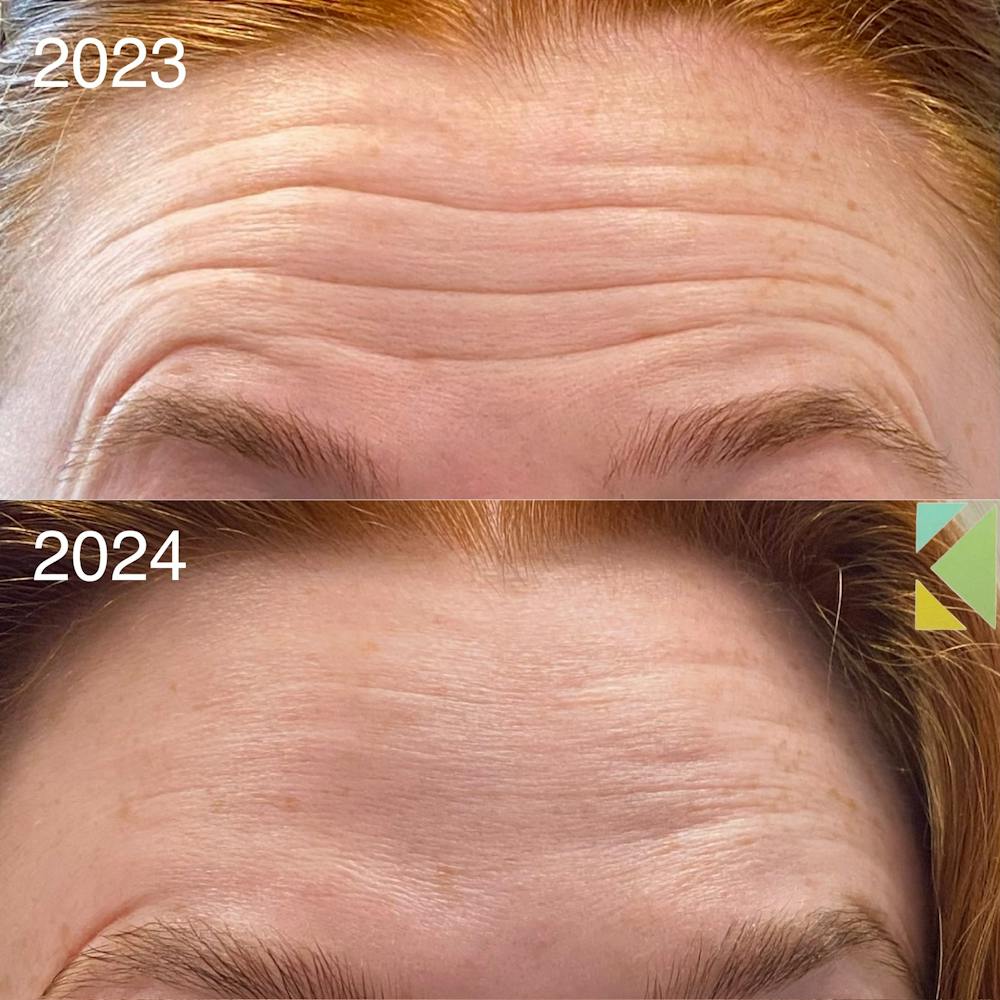 Botox Before & After Gallery - Patient 184390 - Image 1