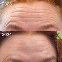 Botox Before & After Gallery - Patient 184390 - Image 1