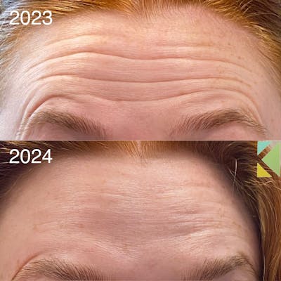 Botox Before & After Gallery - Patient 184390 - Image 1