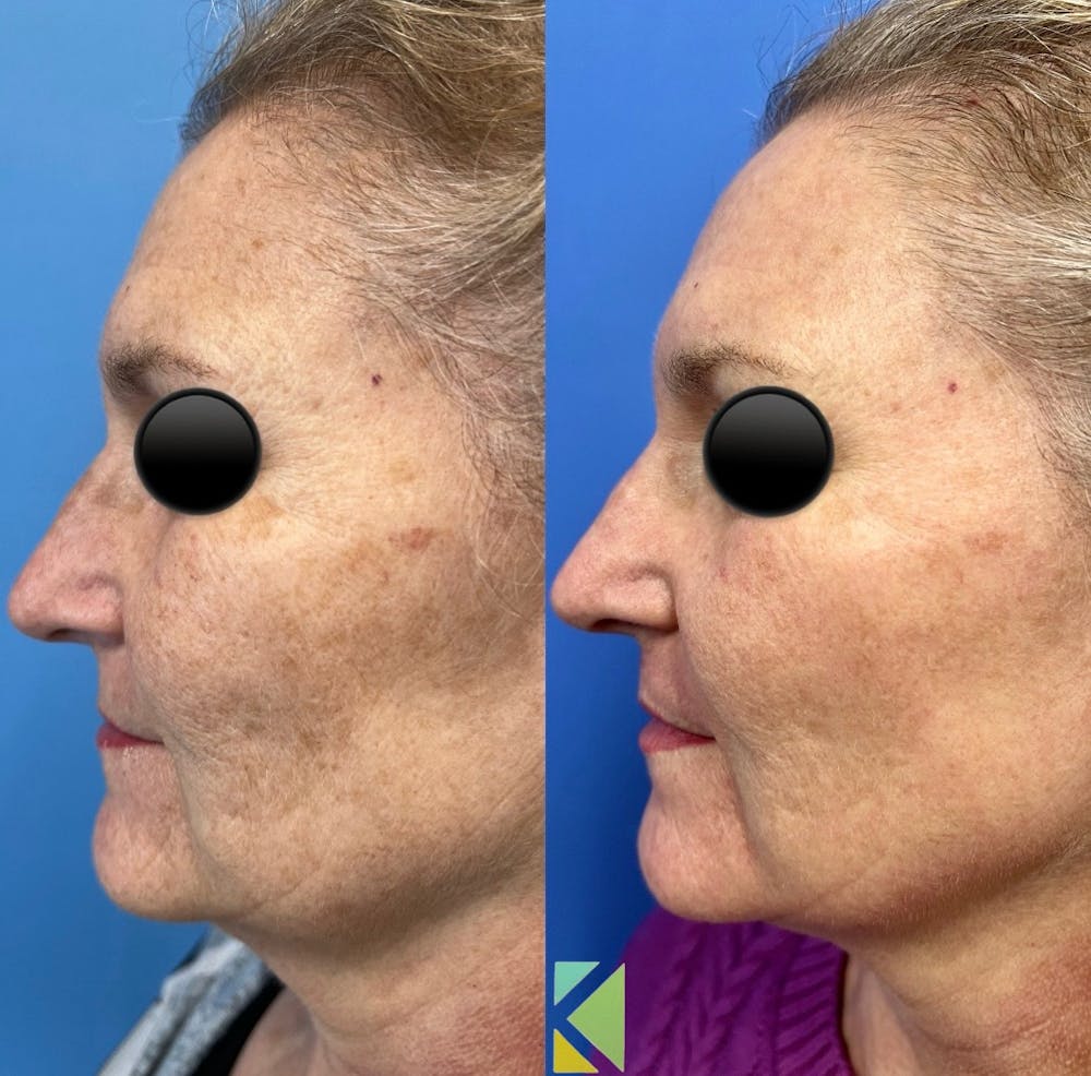CO2 Laser Resurfacing Before & After Gallery - Patient 386608 - Image 1
