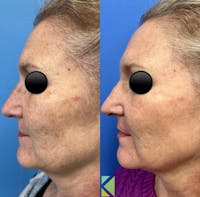 CO2 Laser Resurfacing Before & After Gallery - Patient 386608 - Image 1