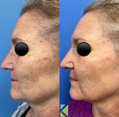 CO2 Laser Resurfacing Before & After Gallery - Patient 386608 - Image 1
