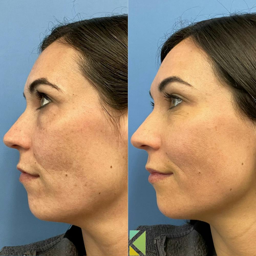 CO2 Laser Resurfacing Before & After Gallery - Patient 272214 - Image 1