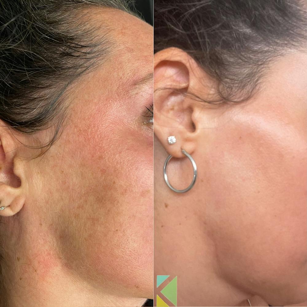 CO2 Laser Resurfacing Before & After Gallery - Patient 481379 - Image 1