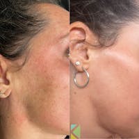 CO2 Laser Resurfacing Before & After Gallery - Patient 481379 - Image 1