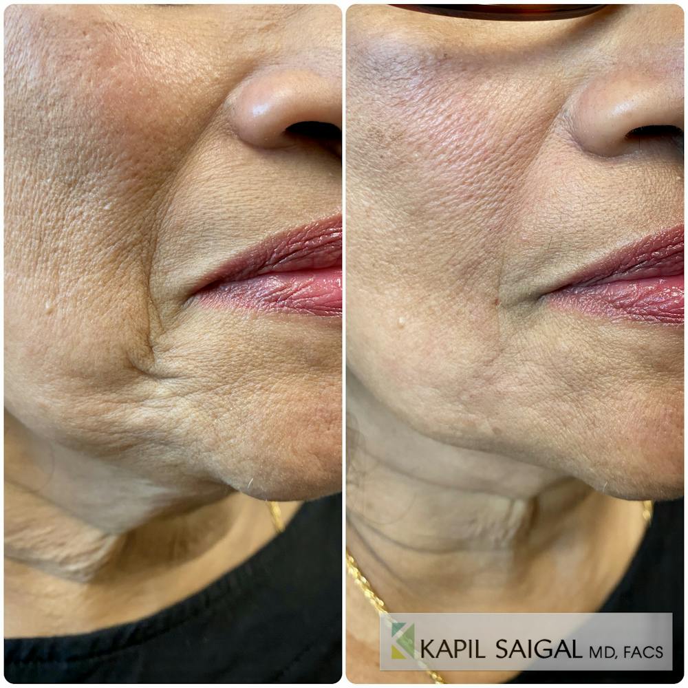CO2 Laser Resurfacing Before & After Gallery - Patient 165275 - Image 2