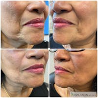 CO2 Laser Resurfacing Before & After Gallery - Patient 165275 - Image 1