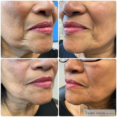 CO2 Laser Resurfacing Before & After Gallery - Patient 165275 - Image 1