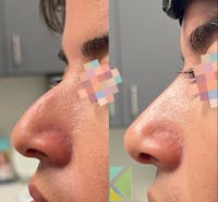 Non-Surgical Rhinoplasty Before & After Gallery - Patient 129155 - Image 1