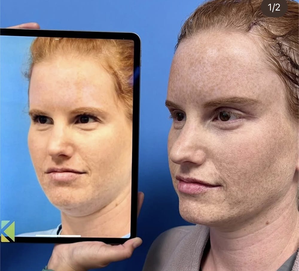 Brow Lift Before & After Gallery - Patient 402926 - Image 1