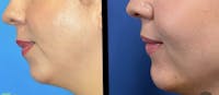Chin Augmentation Before & After Gallery - Patient 316574 - Image 1
