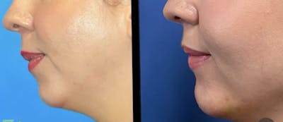 Chin Augmentation Before & After Gallery - Patient 316574 - Image 1