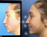 Chin Augmentation Before & After Gallery - Patient 944898 - Image 1