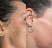 CO2 Laser Resurfacing Before & After Gallery - Patient 216328 - Image 1