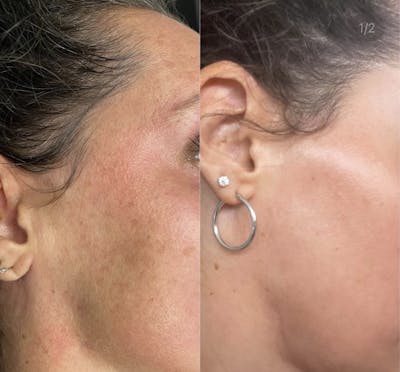 CO2 Laser Resurfacing Before & After Gallery - Patient 216328 - Image 1