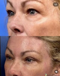 Eyelid Surgery Before & After Gallery - Patient 402451 - Image 1