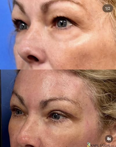 Eyelid Surgery Before & After Gallery - Patient 402451 - Image 1
