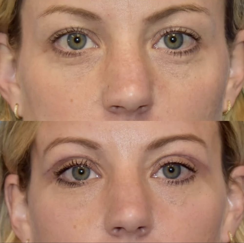 Eyelid Surgery Before & After Gallery - Patient 398630 - Image 1