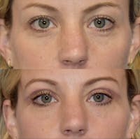 Eyelid Surgery Before & After Gallery - Patient 398630 - Image 1