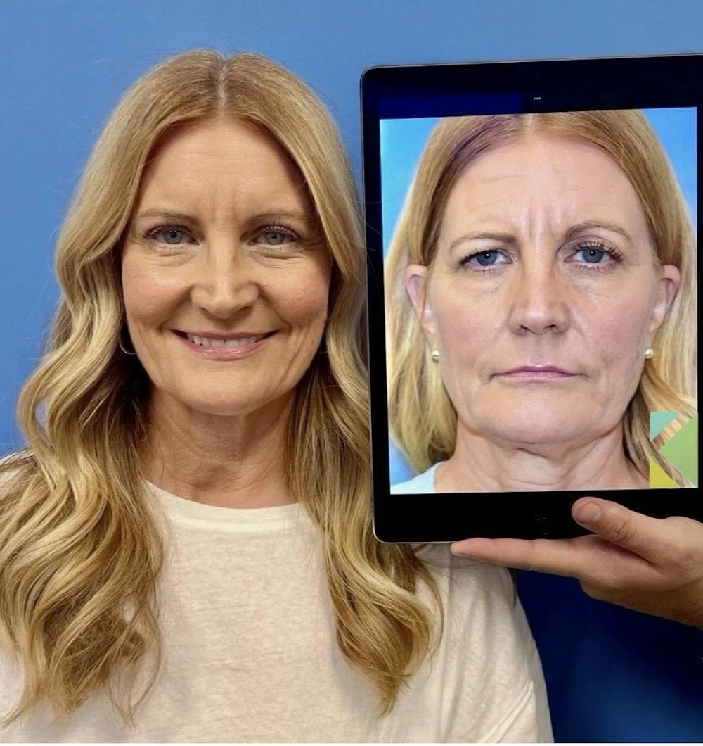 Eyelid Surgery Before & After Gallery - Patient 177479 - Image 1