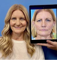 Eyelid Surgery Before & After Gallery - Patient 177479 - Image 1