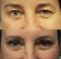 Eyelid Surgery Before & After Gallery - Patient 401641 - Image 1