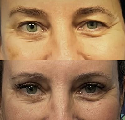 Eyelid Surgery Before & After Gallery - Patient 401641 - Image 1
