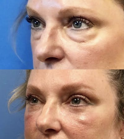Eyelid Surgery Before & After Gallery - Patient 287594 - Image 1