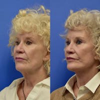 Facelift & Neck Lift Before & After Gallery - Patient 760256 - Image 1