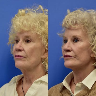 Facelift & Neck Lift Before & After Gallery - Patient 760256 - Image 1