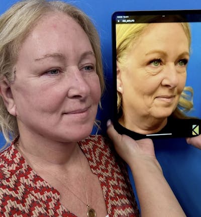 Facelift & Neck Lift Before & After Gallery - Patient 282454 - Image 1