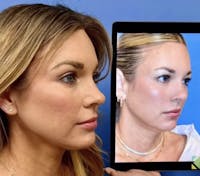 Facelift & Neck Lift Before & After Gallery - Patient 299679 - Image 1