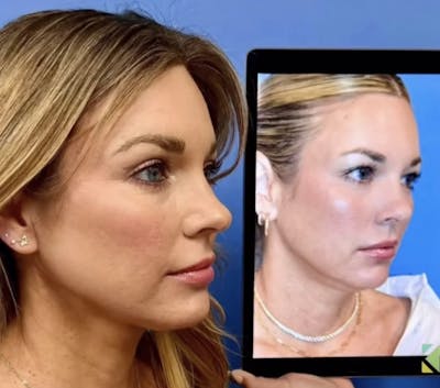 Facelift & Neck Lift Before & After Gallery - Patient 299679 - Image 1